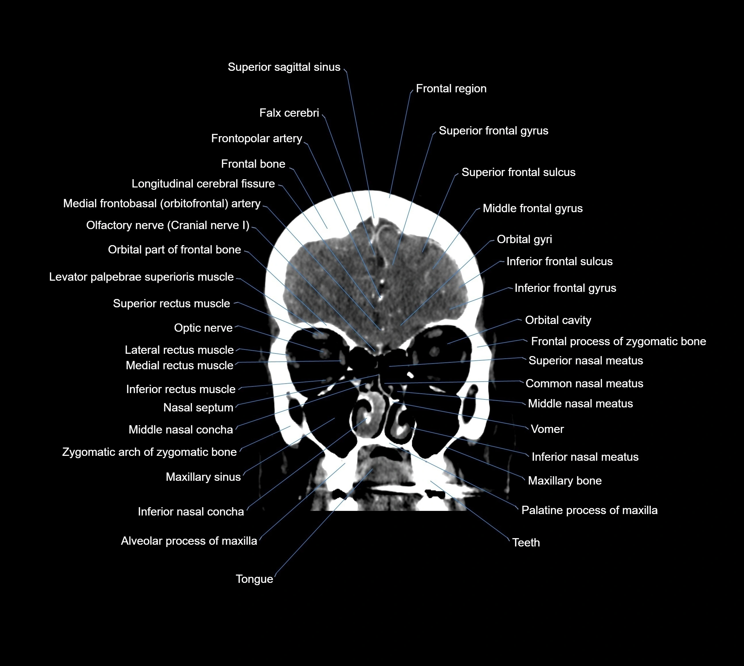 CT Brain coronal cross sectional radiology anatomy image  -img-00001-011.webp